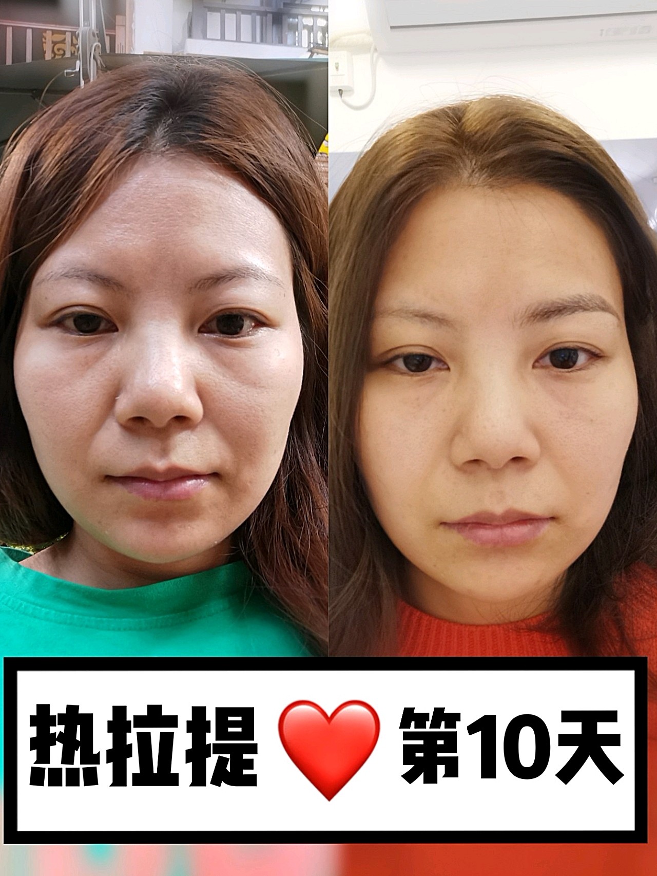 热拉提plus体验官16615首图是前后对比无滤镜,_圈子-新氧美容