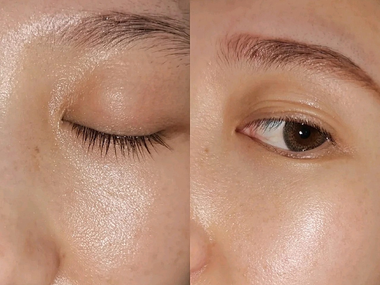 前段时间做完黄金微针以后.