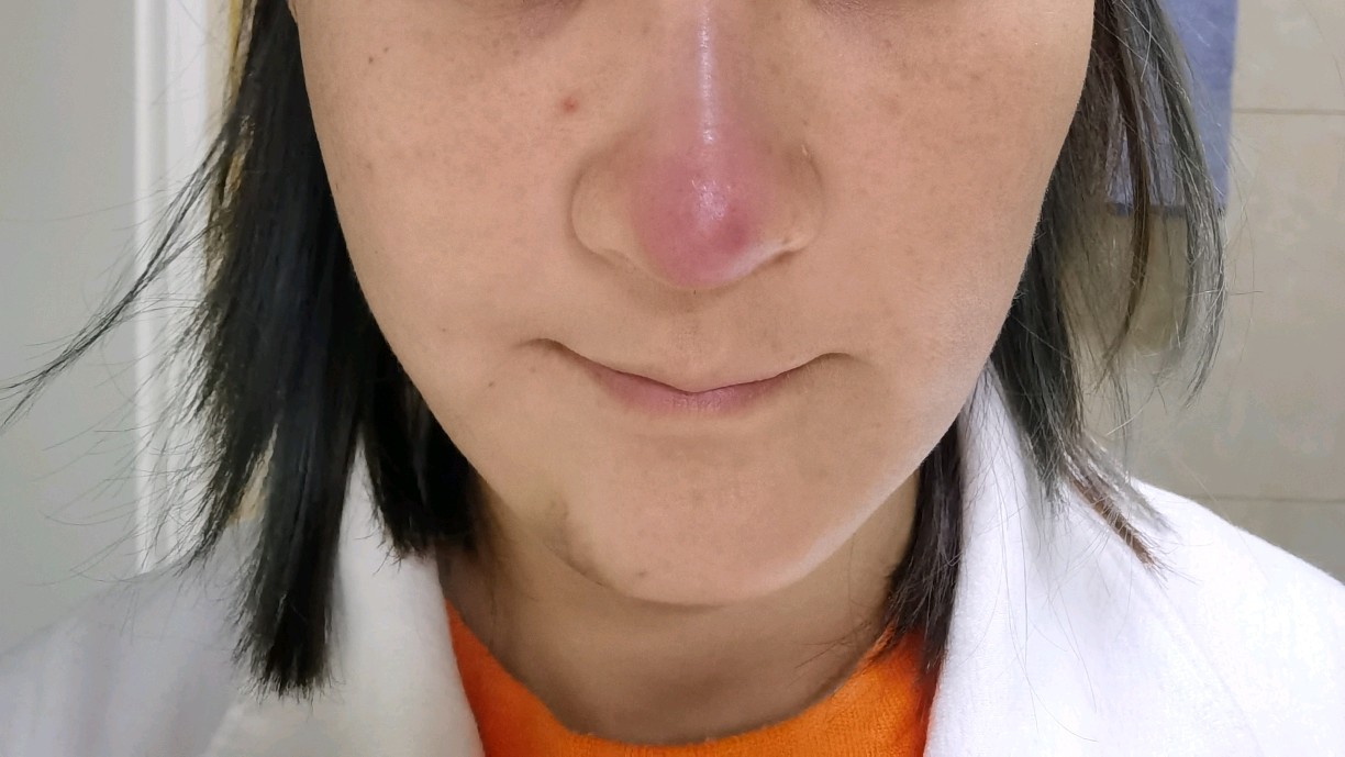 隆鼻鼻头红感染图片图片
