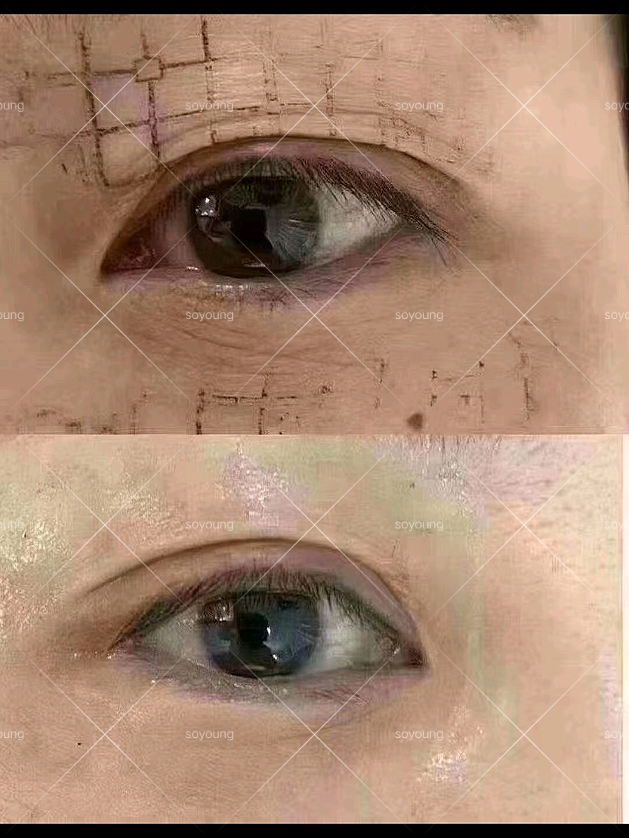 热玛吉眼周体验,效果是真的棒!