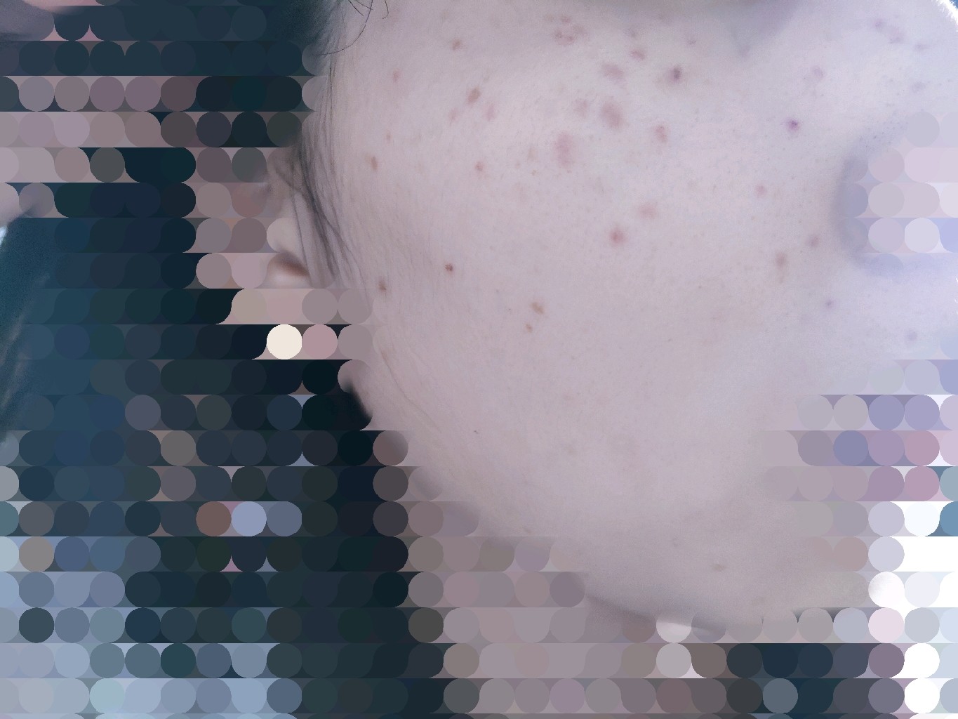 大部分变成红褐色的印子12颗开始结痂