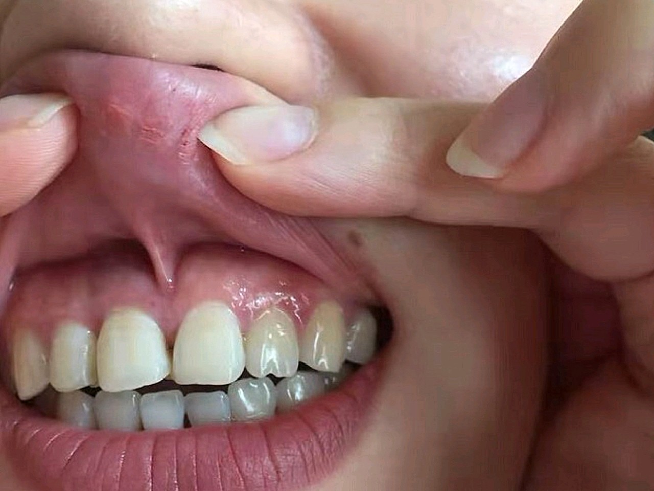 门牙意外断掉了,当时考虑做烤瓷牙的,但是要磨掉两侧_圈子-新氧美容