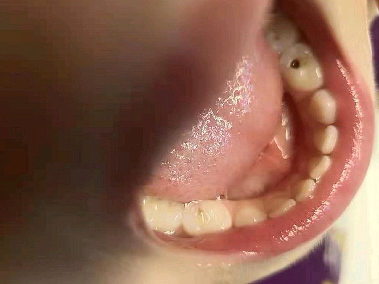 虽然每天都监督小朋友刷牙,但是还是发现一个牙齿有洞