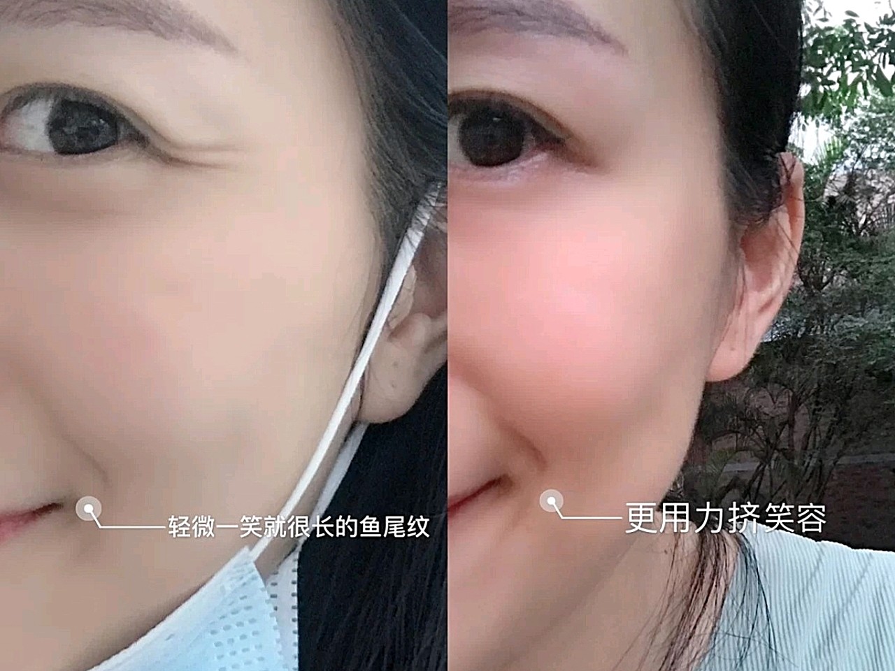 鱼尾纹,抬头纹蛮严重的,如果不管的话,过几年动态纹会变成静态