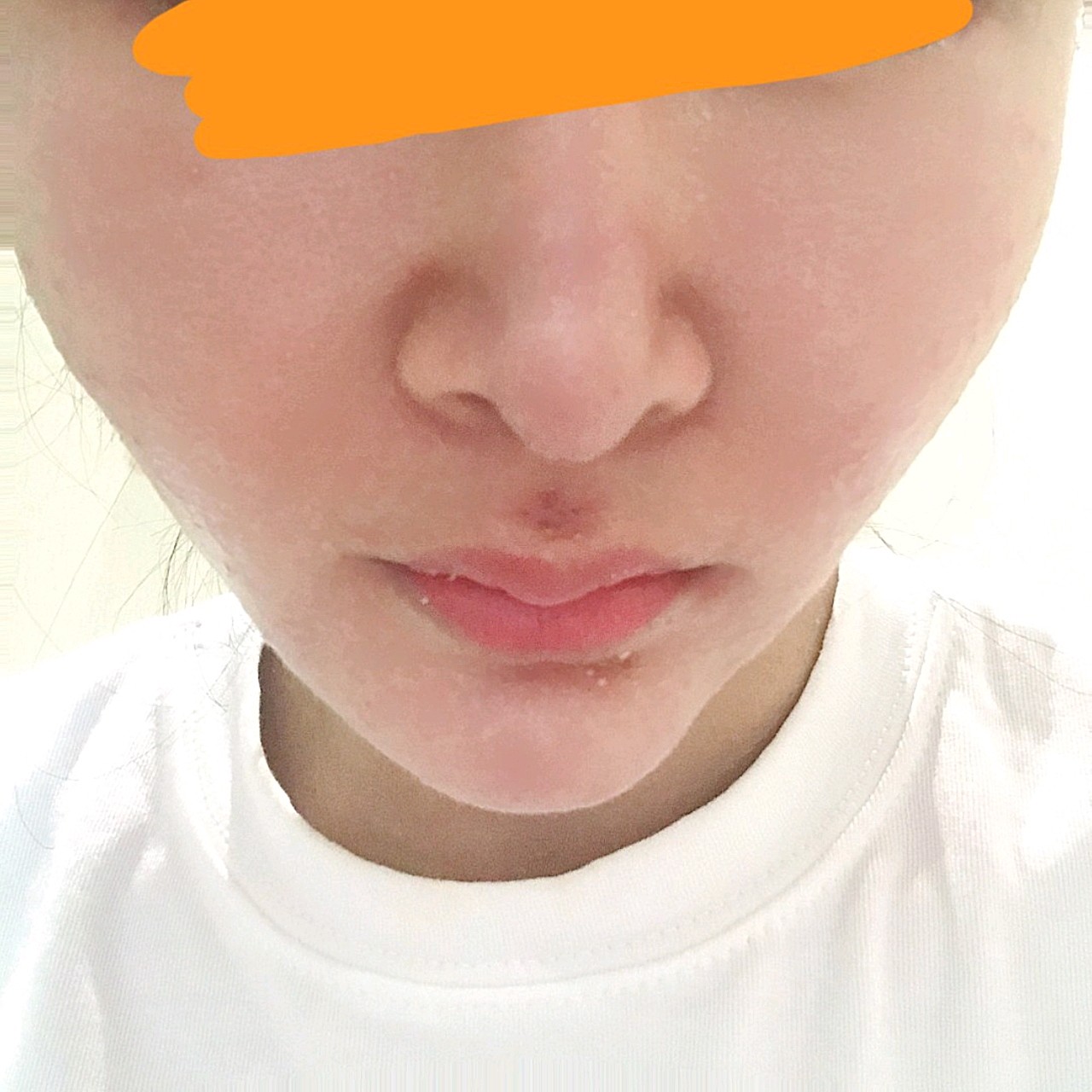 我做的是人中窝加深人中脊重造,看我术前照片就能看出_圈子-新氧美容