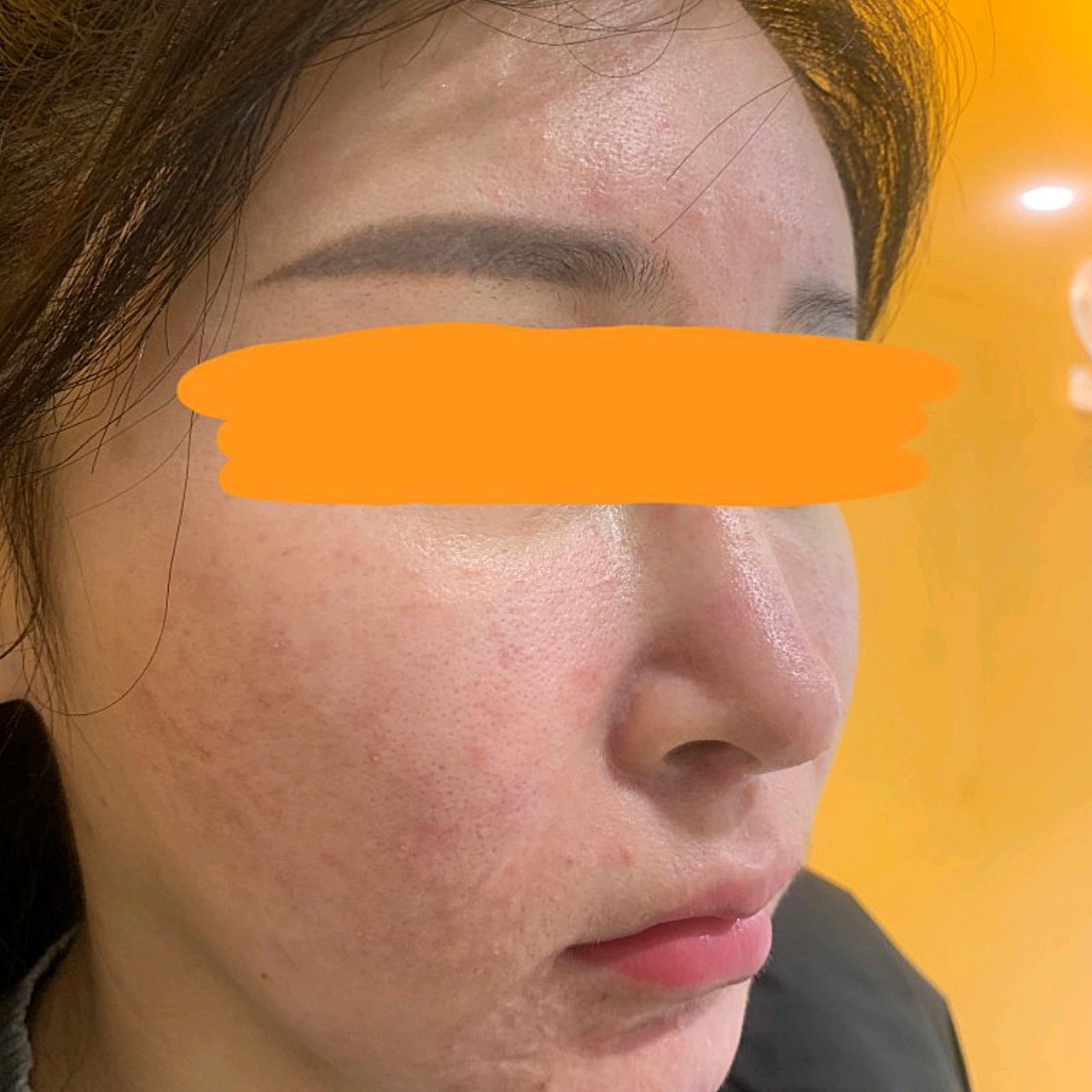 我做的是人中窝加深人中脊重造,看我术前照片就能看出_圈子-新氧美容