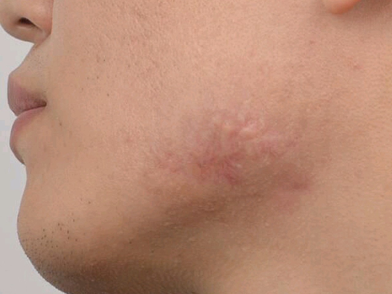 下巴长痘,没想到留下的疤痕还增生了,虽然我是男的但_圈子-新氧美容