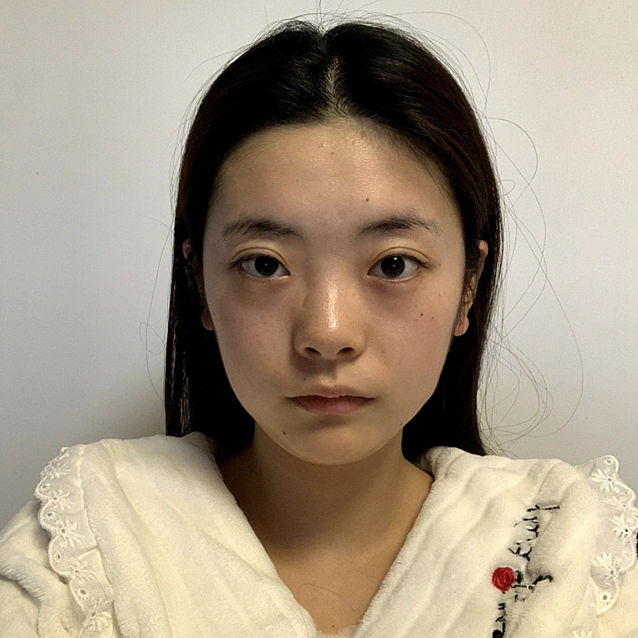 术前诊断面部不对称,面中凹陷,脸型不规则导致"苦大_圈子-新氧美容