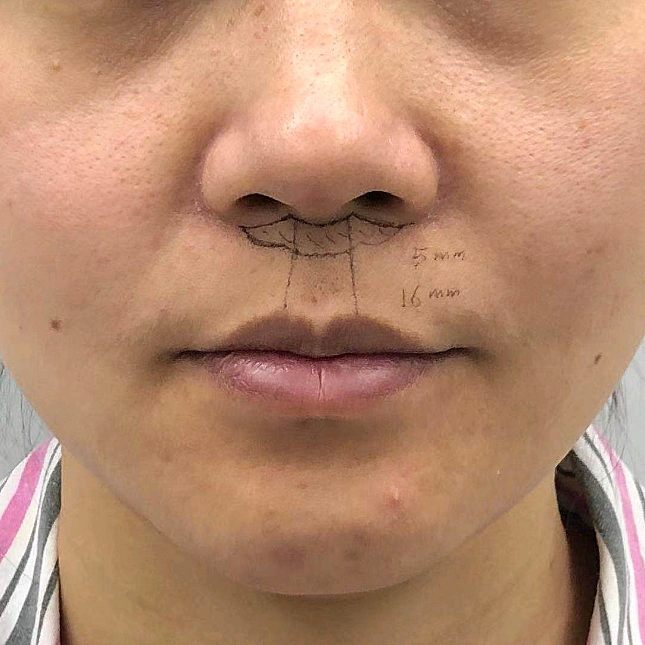 本人正颌后张嘴不漏牙齿人中长显老