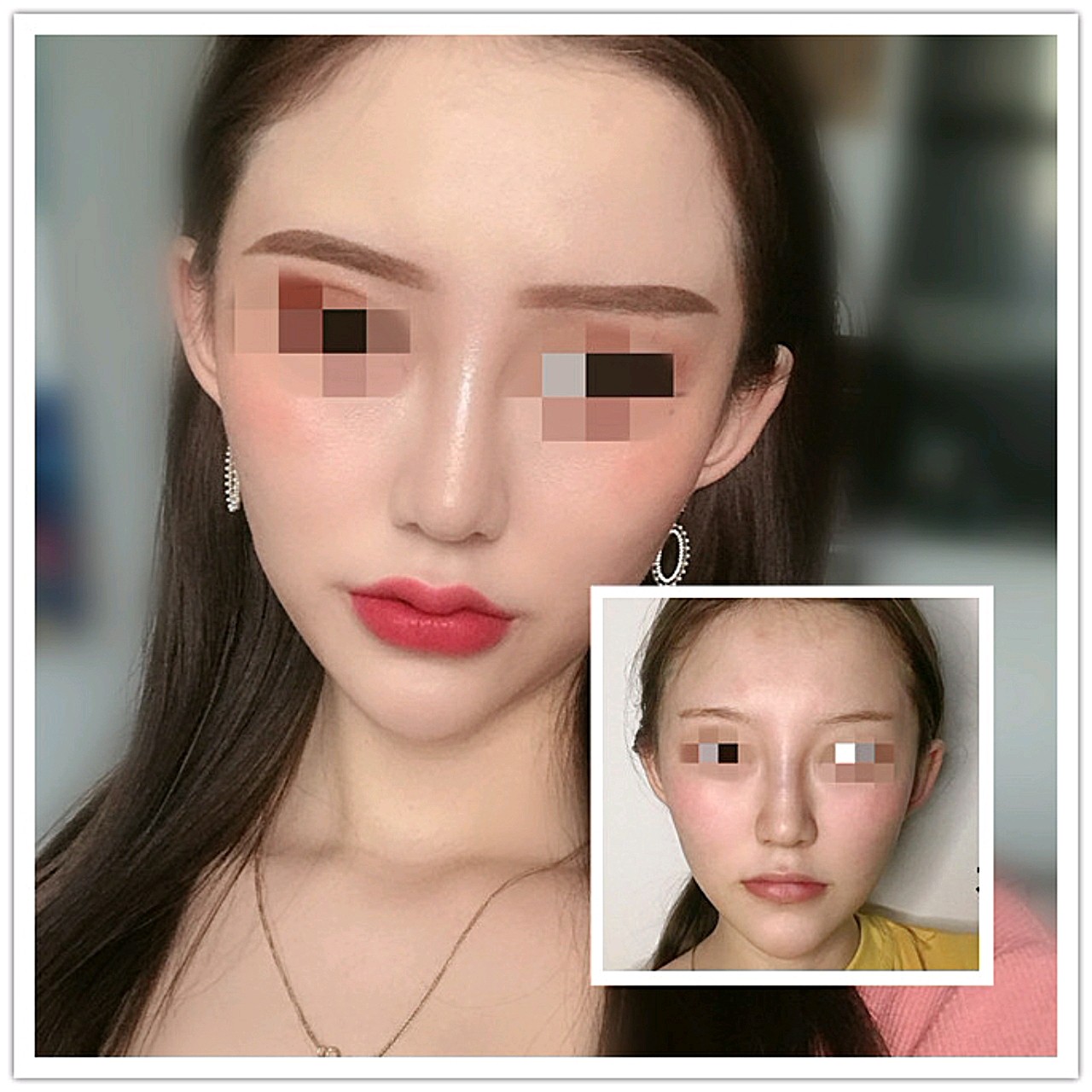 【体验项目】嘟嘟唇半个月前打了嘟嘟唇,现在恢复的非_圈子-新氧美容