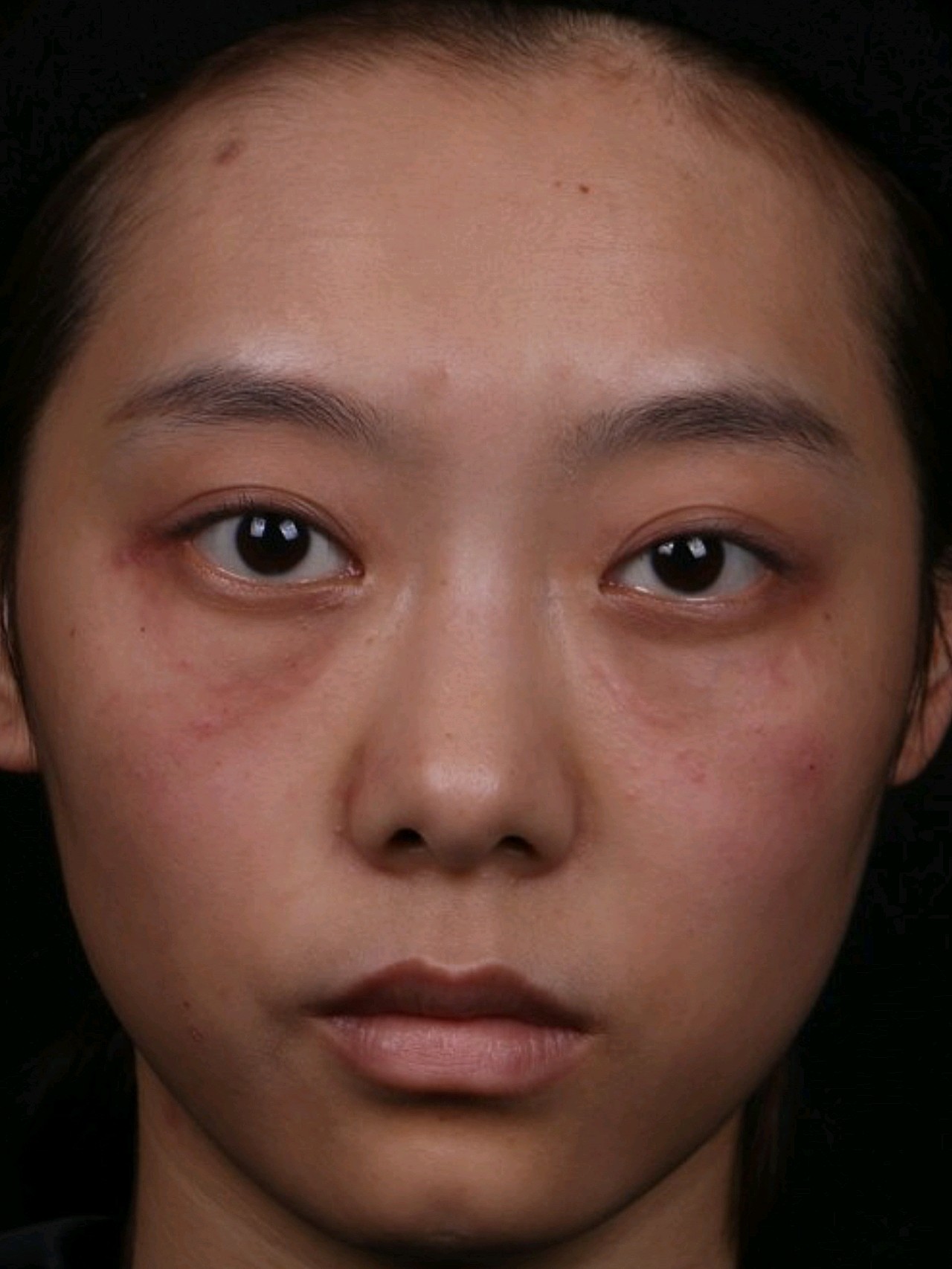 玻尿酸填充泪沟术后即刻