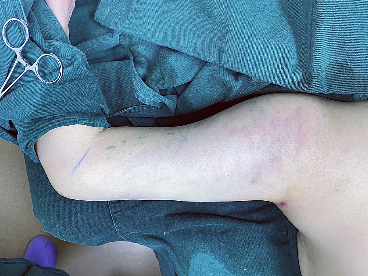 从我手臂上抽出来了好多脂肪,看我_圈子-新氧美容整形