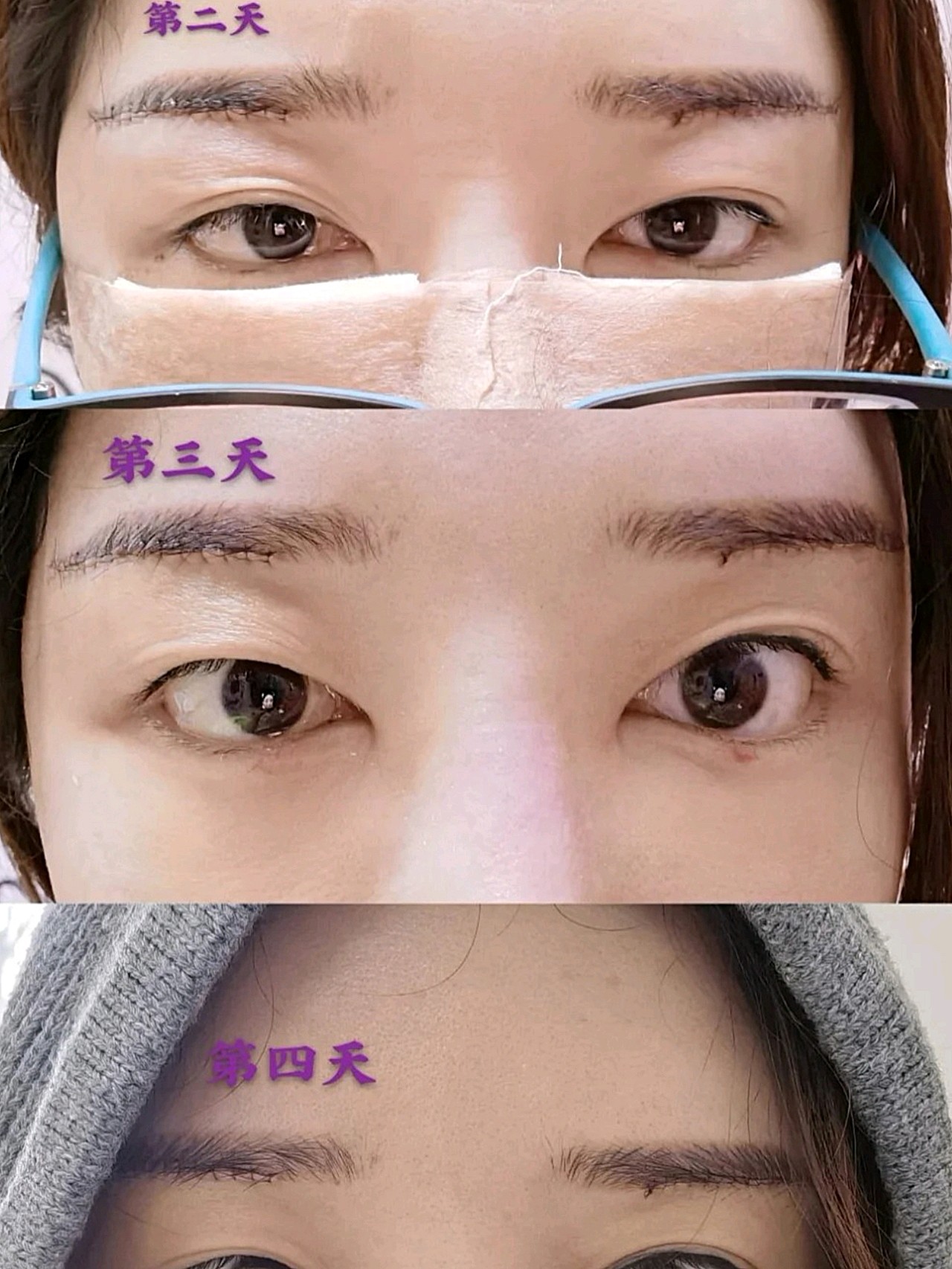 【切眉术】【国家医院 医保定点】提眉切眉术 眉形改善 微创隐痕 四重
