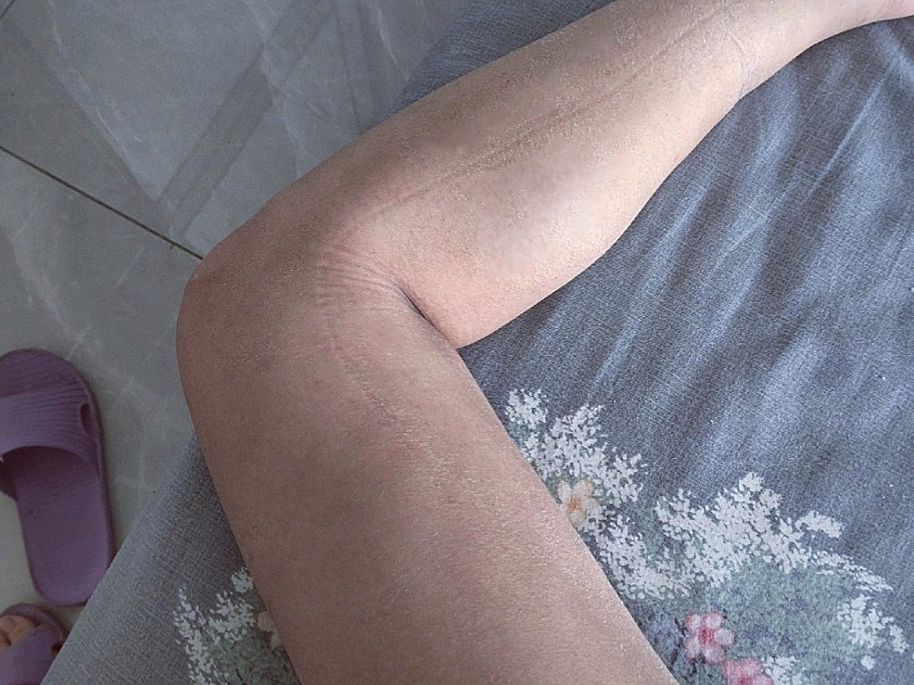 其实不算胖,就是腿上有好多肉肉堆积着,尤其是大腿,_圈子-新氧美容