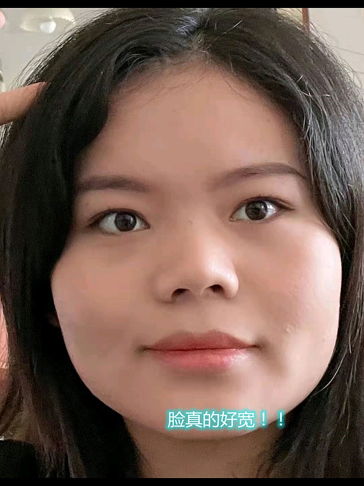 像我这样咬肌贼大的亲,真的可以打个瘦脸针,我打了之_圈子-新氧美容