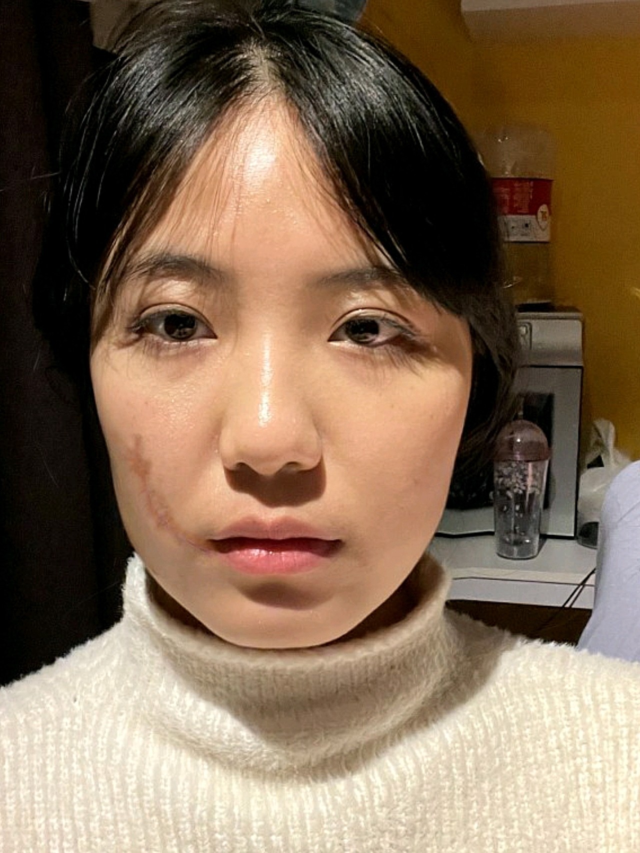 留下了比较严重的色素痕迹,因为面积比较大,而且色素疤痕形态很难看