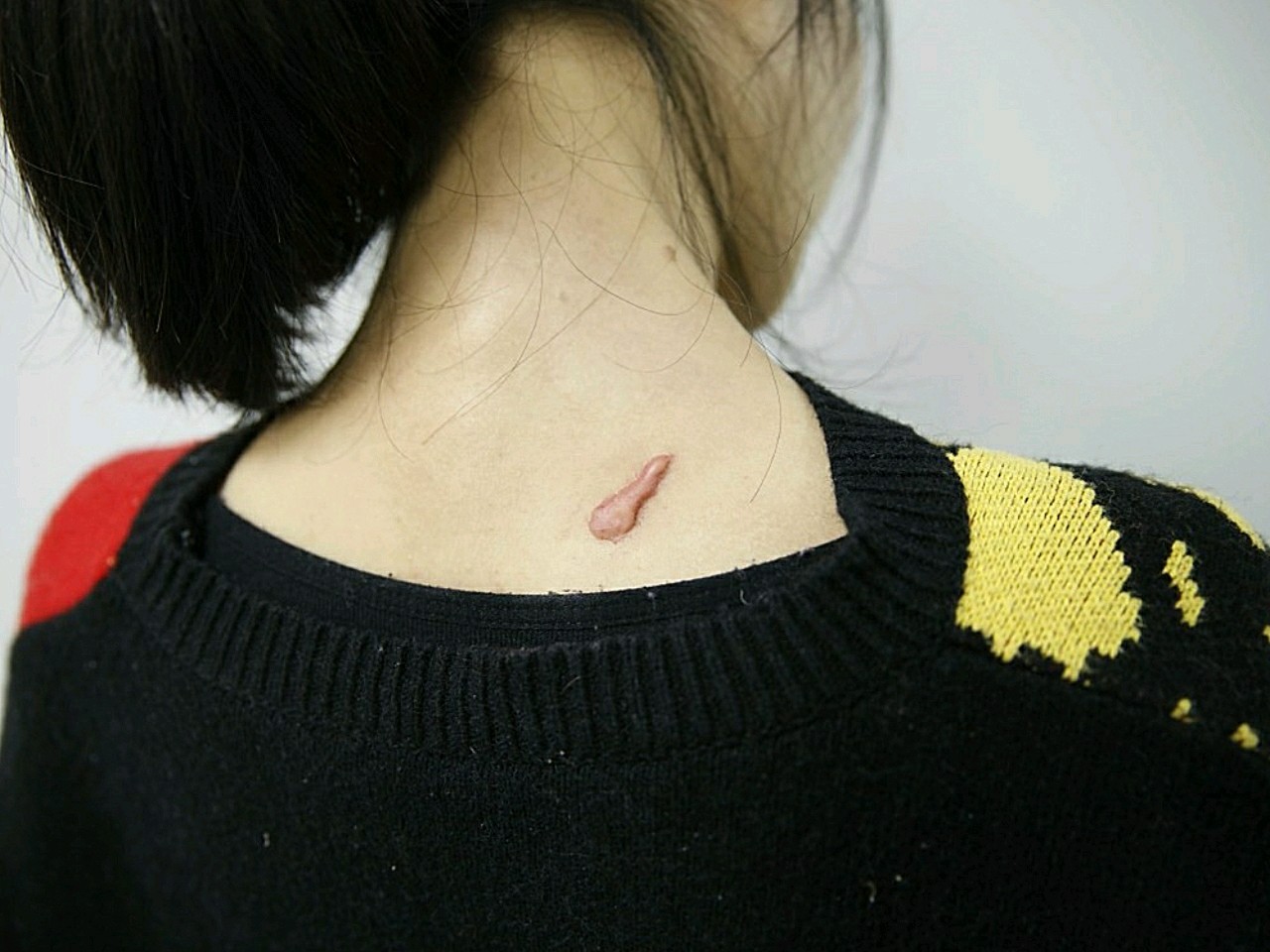 原本背上有一个比较大的增生疤痕疙瘩的当时很担心,后_圈子-新氧美容