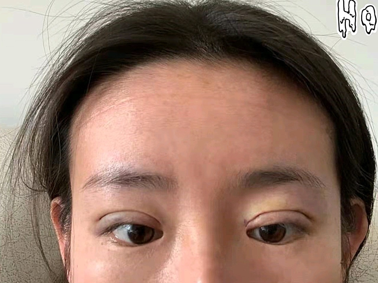 天生内双,做的埋线双眼皮,一开始还是有些肿的,到两_圈子-新氧美容