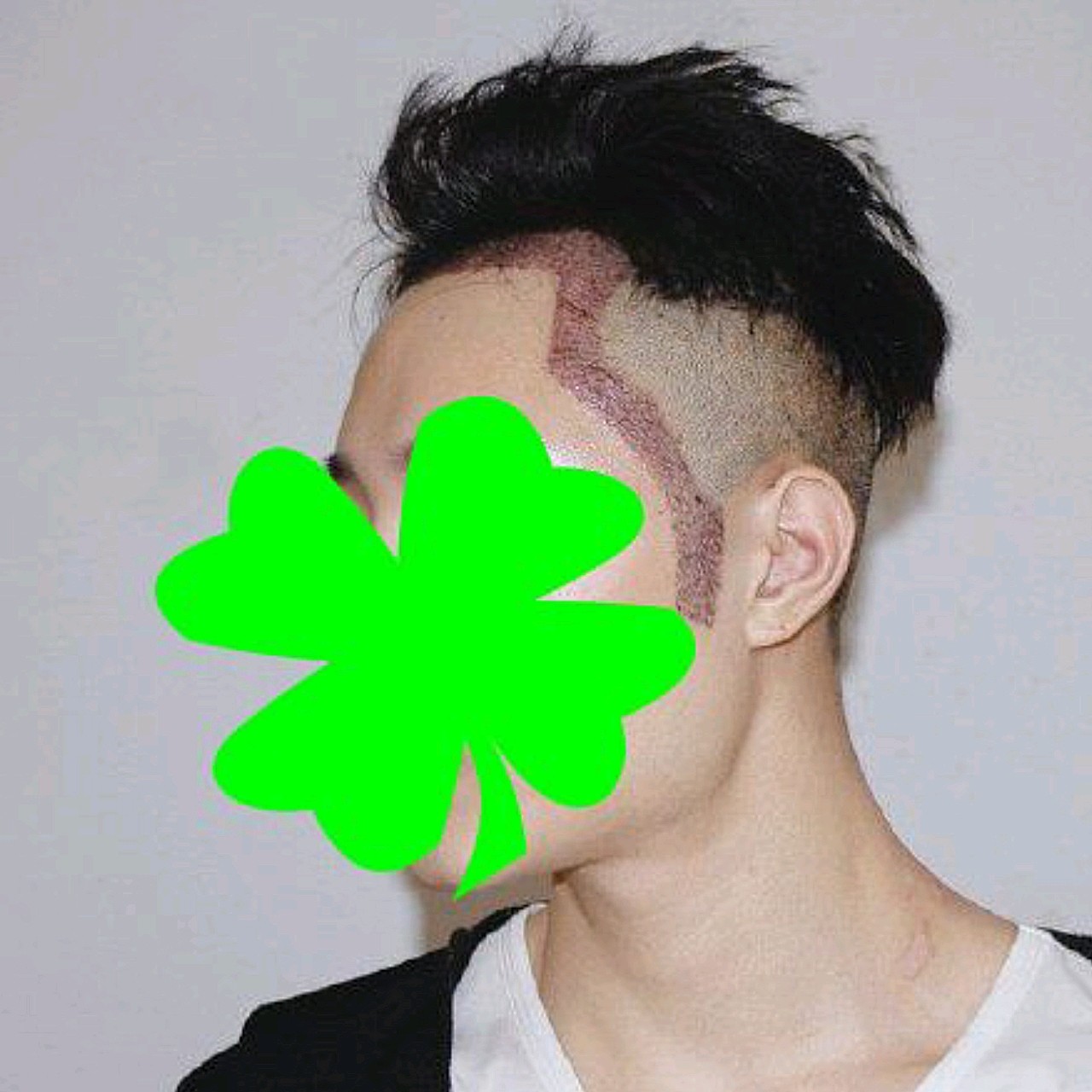 种植发际线的时候,为了发际线更有型,顺手做了鬓角种_圈子-新氧美容