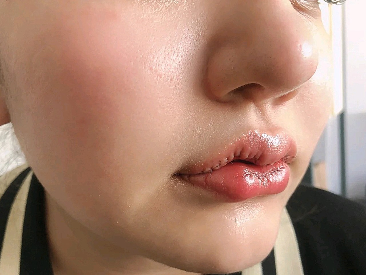 考虑了很久,还是决定把m唇做了,我做的上下双侧,还_圈子-新氧美容整形