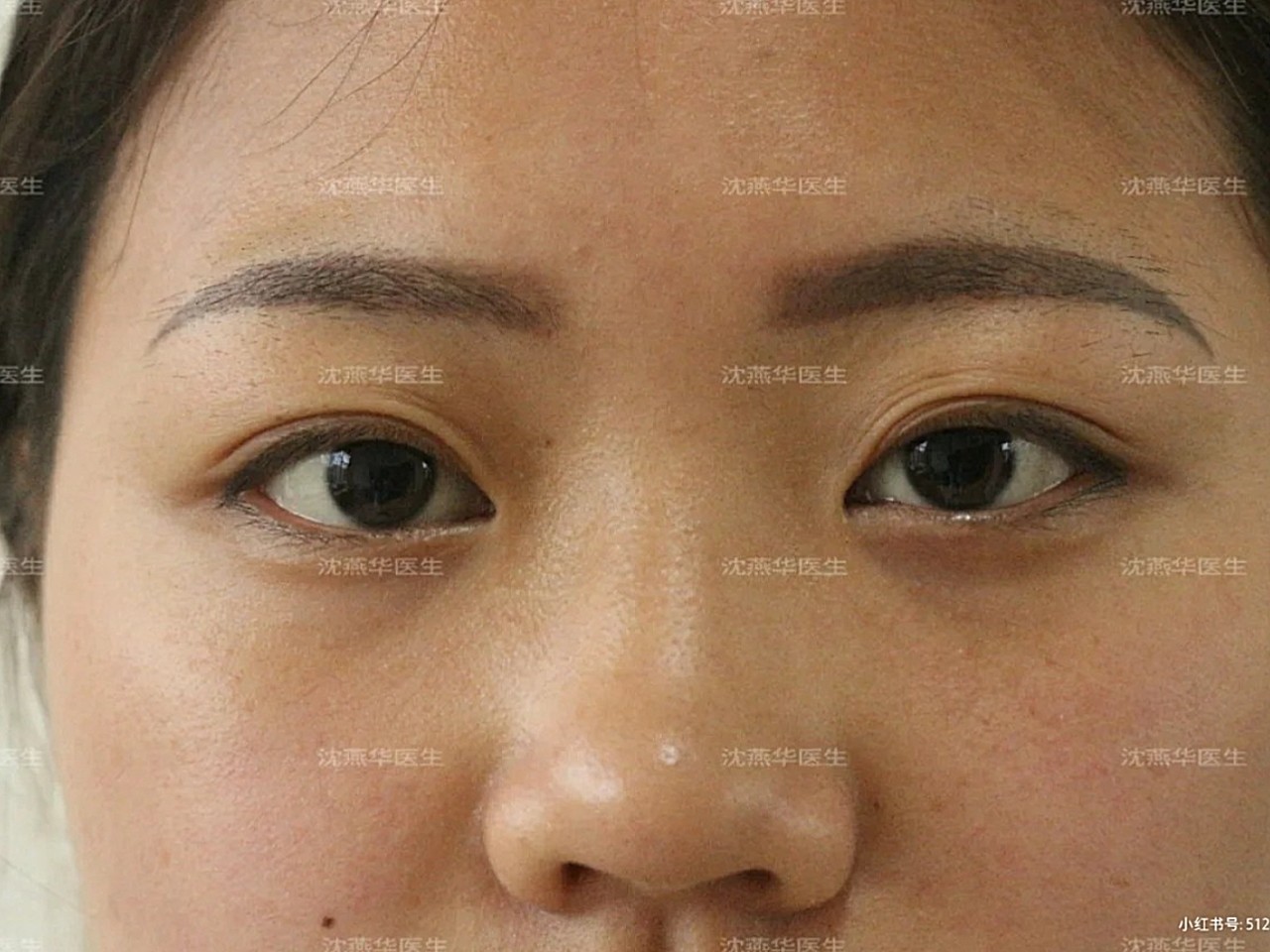 术前诊断方案设计手术总结78初眼眼部不对称,轻微内眦_圈子-新氧