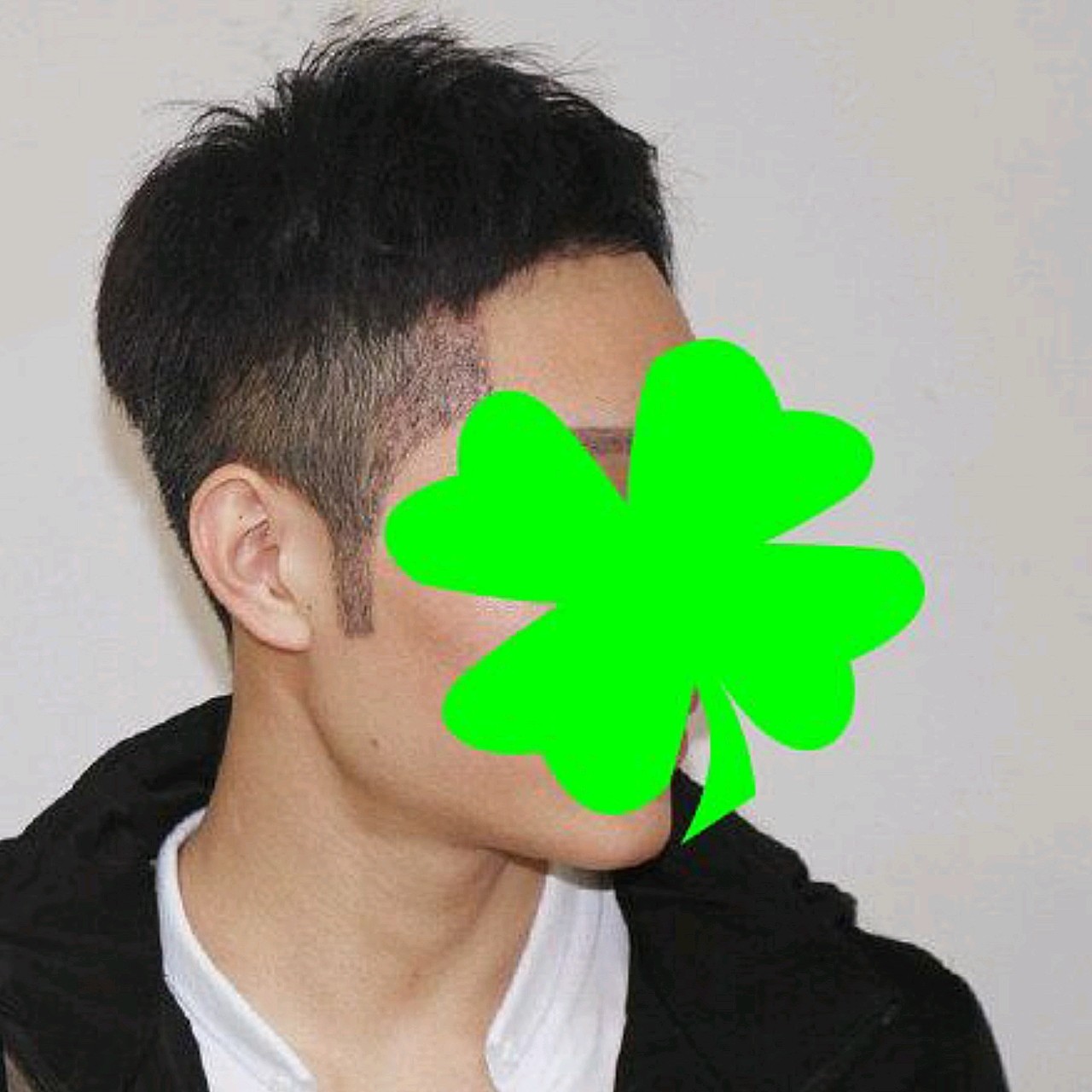 种植发际线的时候,为了发际线更有型,顺手做了鬓角种_圈子-新氧美容