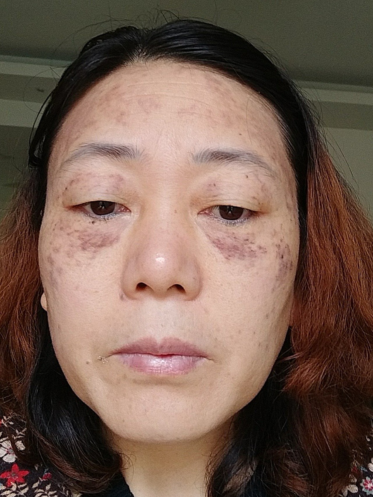 斑的类型太多了,属于的层次,斑种都不一样,在市面上_圈子-新氧美容