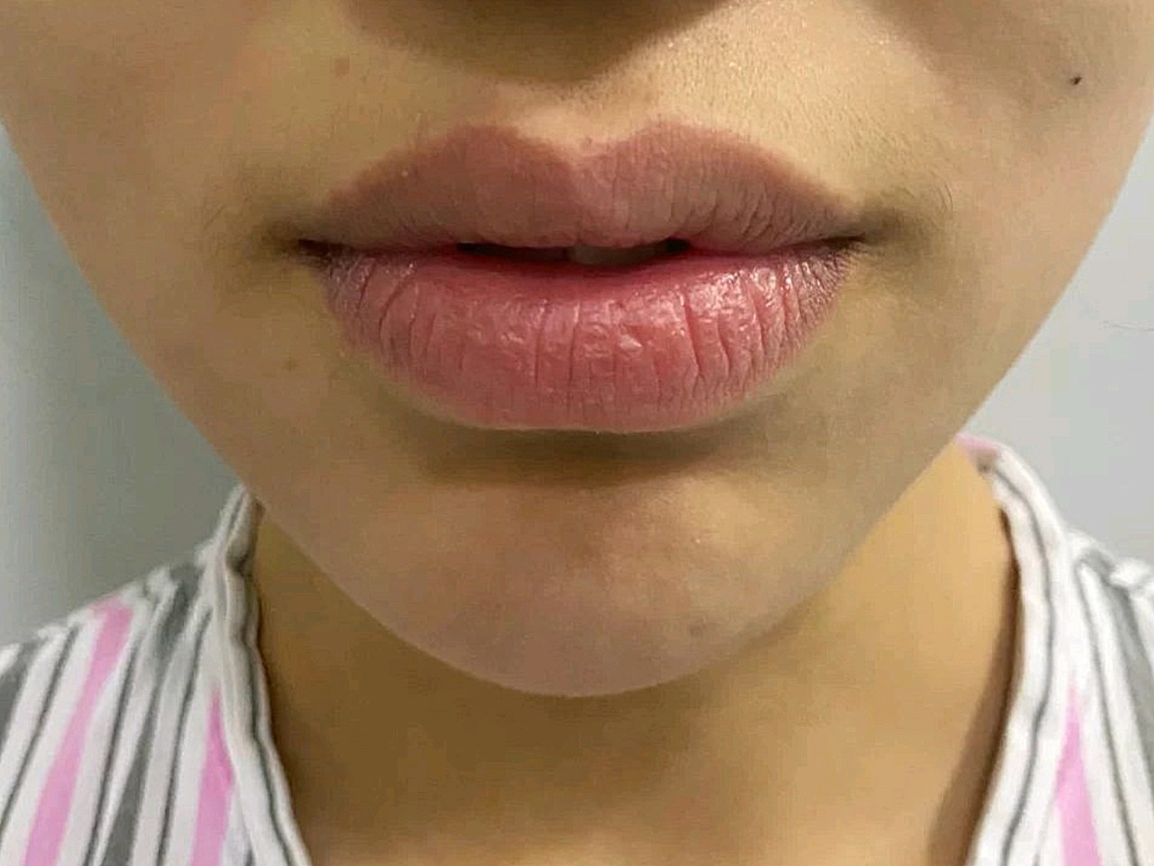 【长春久诺美赵广文m唇厚唇改薄】我的新唇形已经很稳_圈子-新氧美容