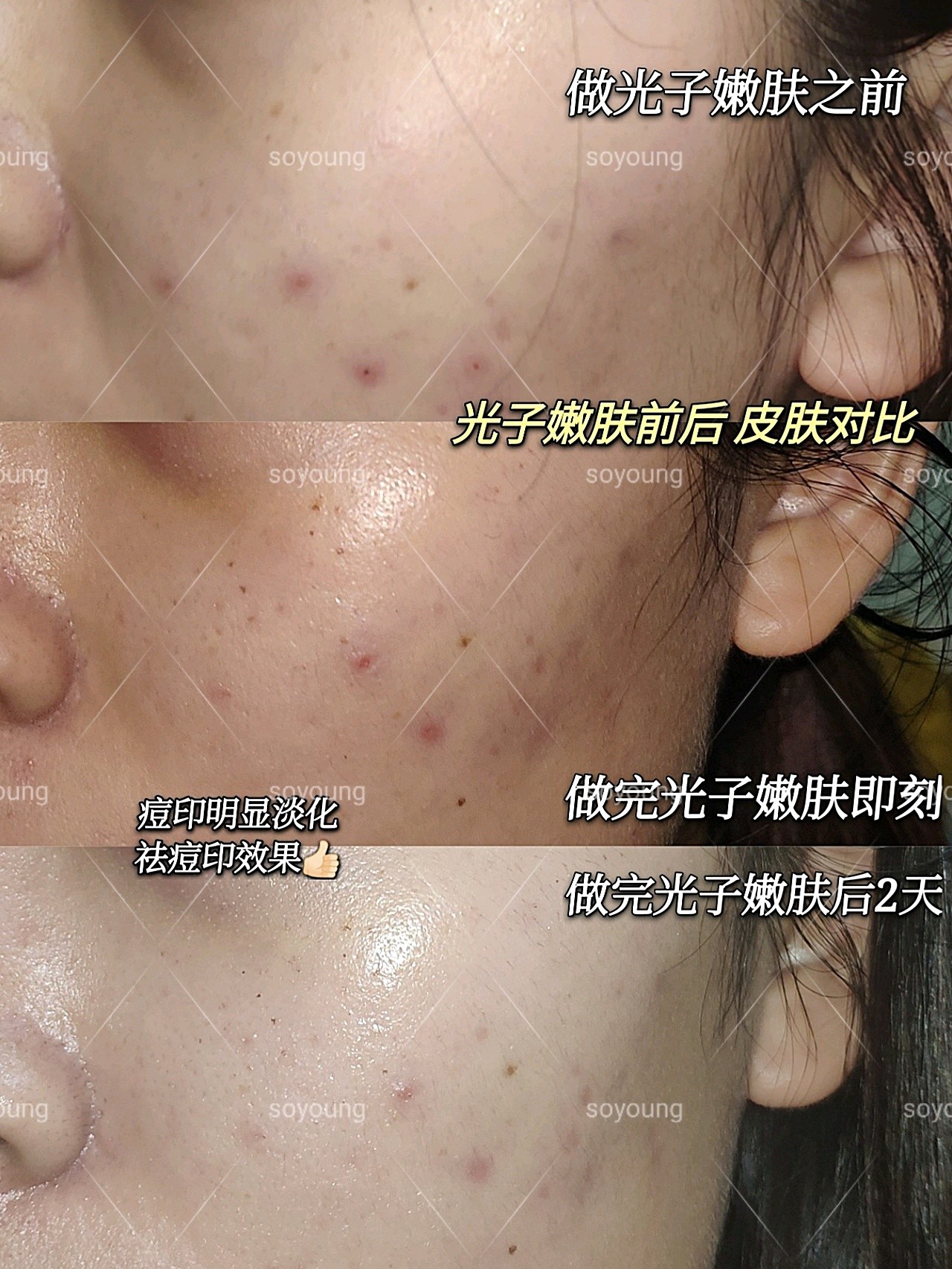 医美大赏-光子嫩肤