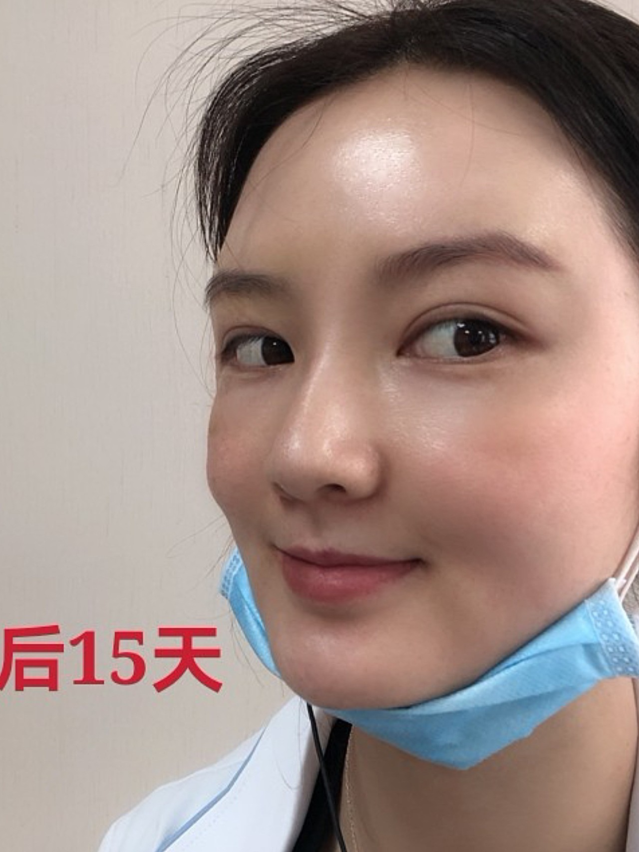 术前诊断随着年龄的增长,皮下脂肪日渐萎缩,皮肤会变_圈子-新氧美容