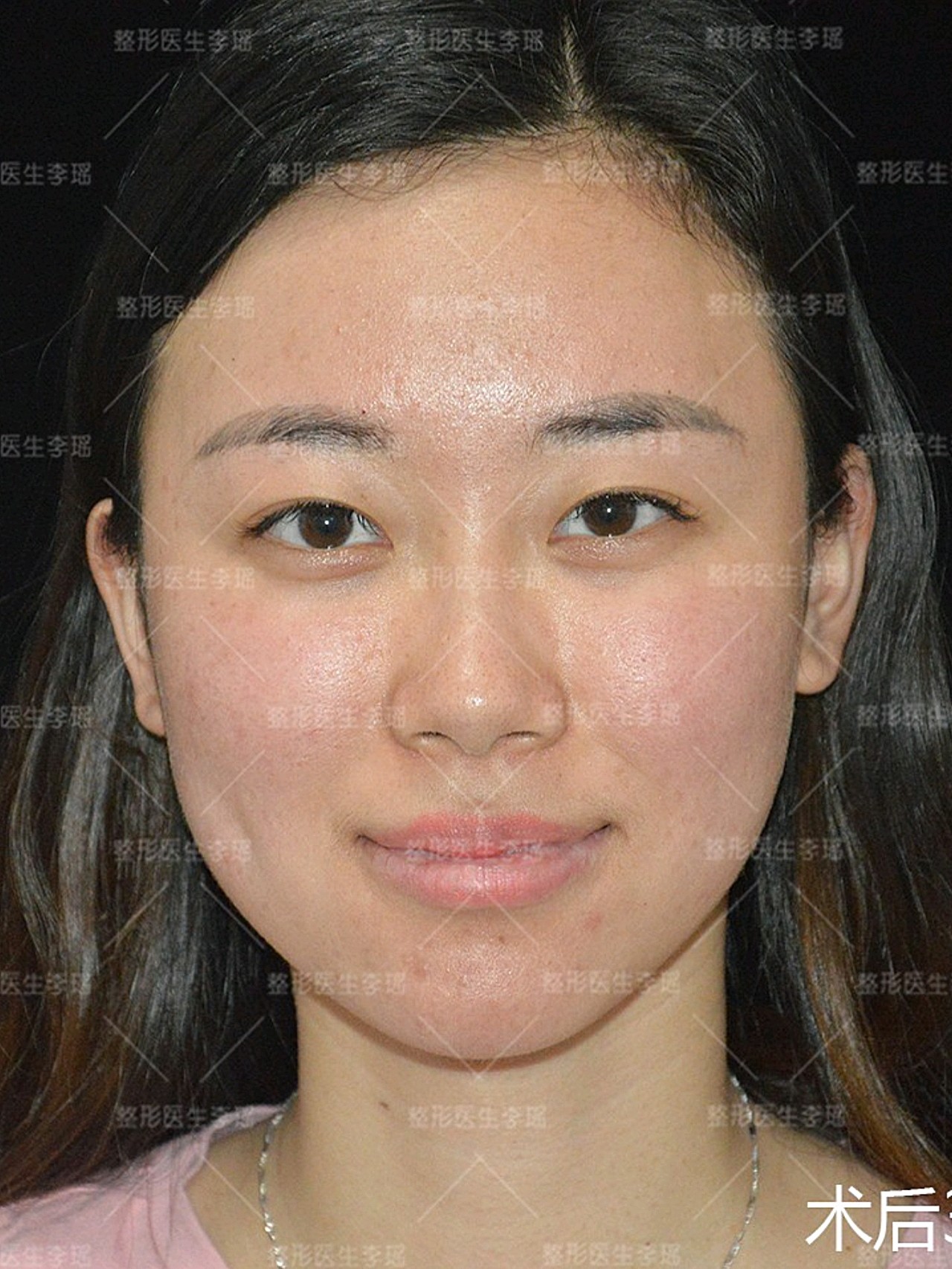 来做填充的小妹说苹果肌1个月之前打过玻尿酸问我可不可以直接作填充