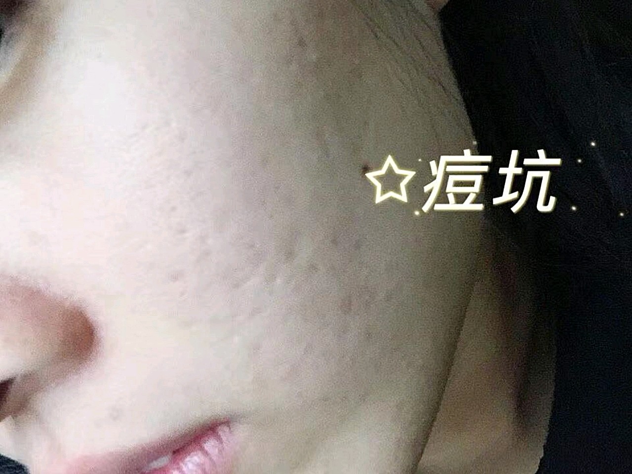 治疗前面部的痘坑有点多脸坑坑哇哇的捂脸