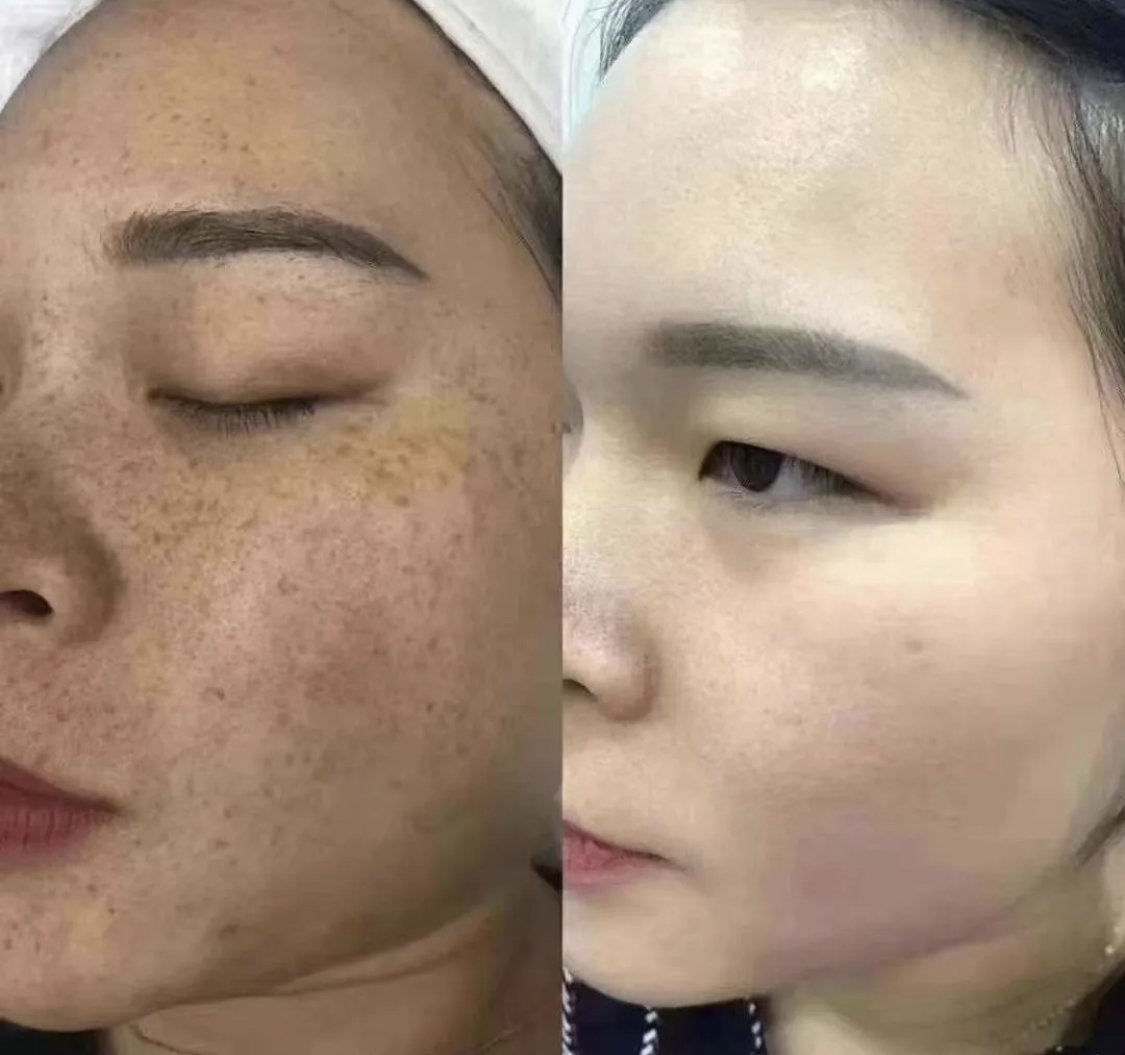 雀斑要去除真的是一个漫长的过程,不要以为做了一次就_圈子-新氧美容