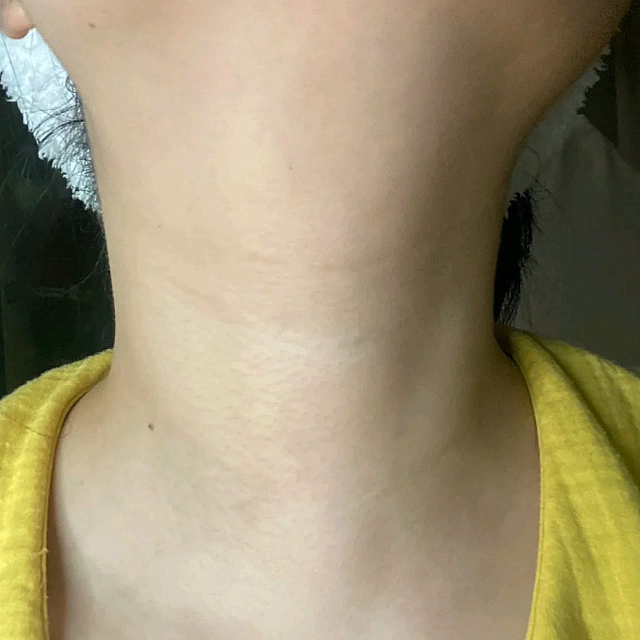 我之前的颈纹很严重,感觉影响美观,从网上了解到你美_圈子-新氧美容