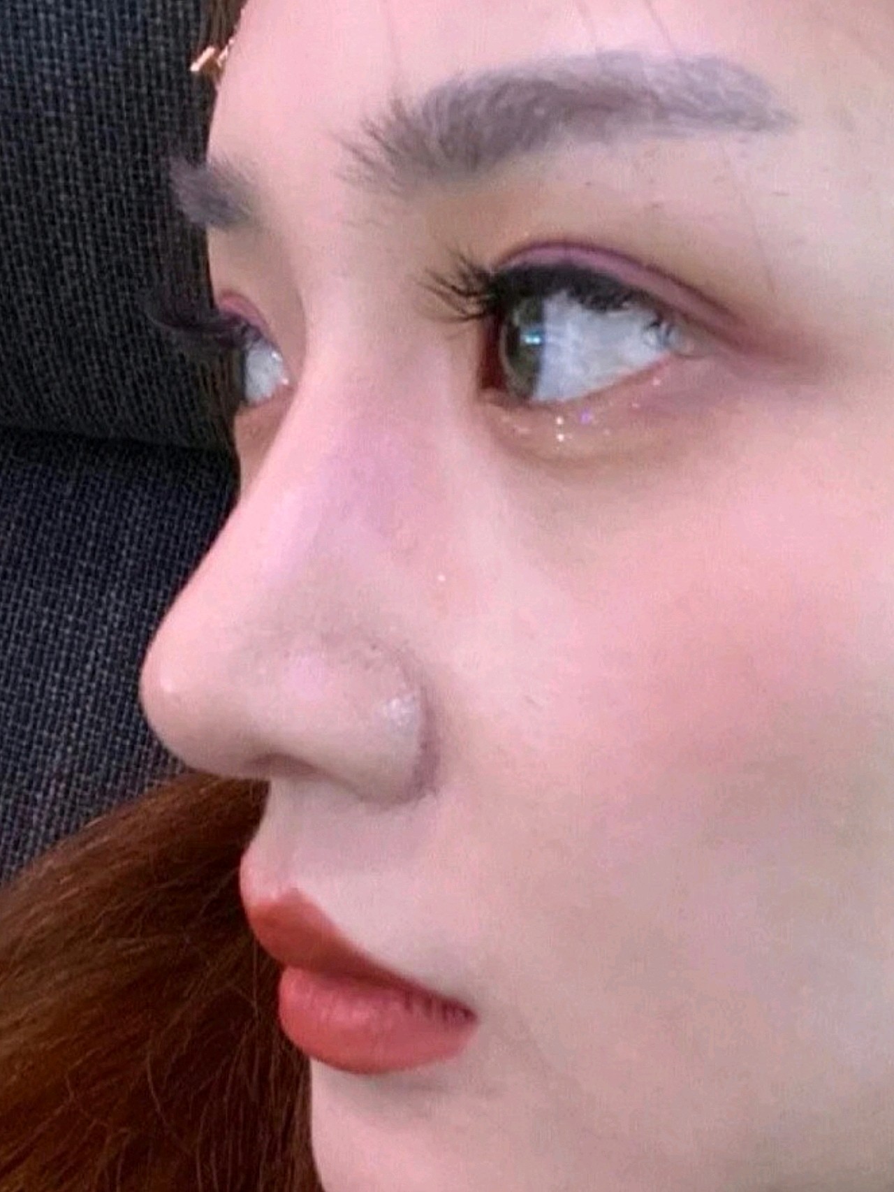 做完手术鼻子就立体了很多,终于变成了完美侧脸型,9_圈子-新氧美容