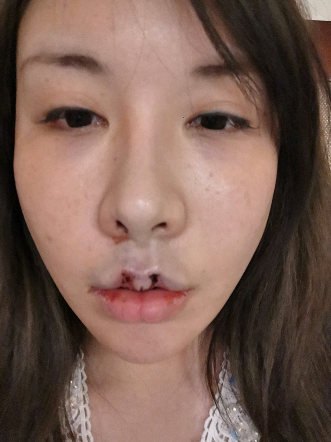 【人中缩短术】速愈美线雕缩人中,避免疤痕免缝合,埋线缩4~6毫米,内外