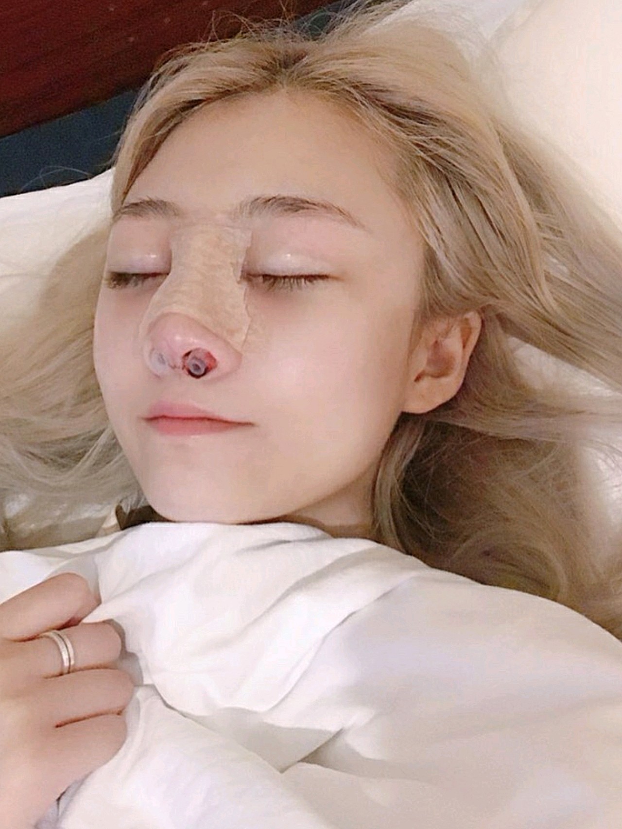 96现在是隆完鼻的第一天,我的鼻子里面还有引流管,因_圈子-新氧美容