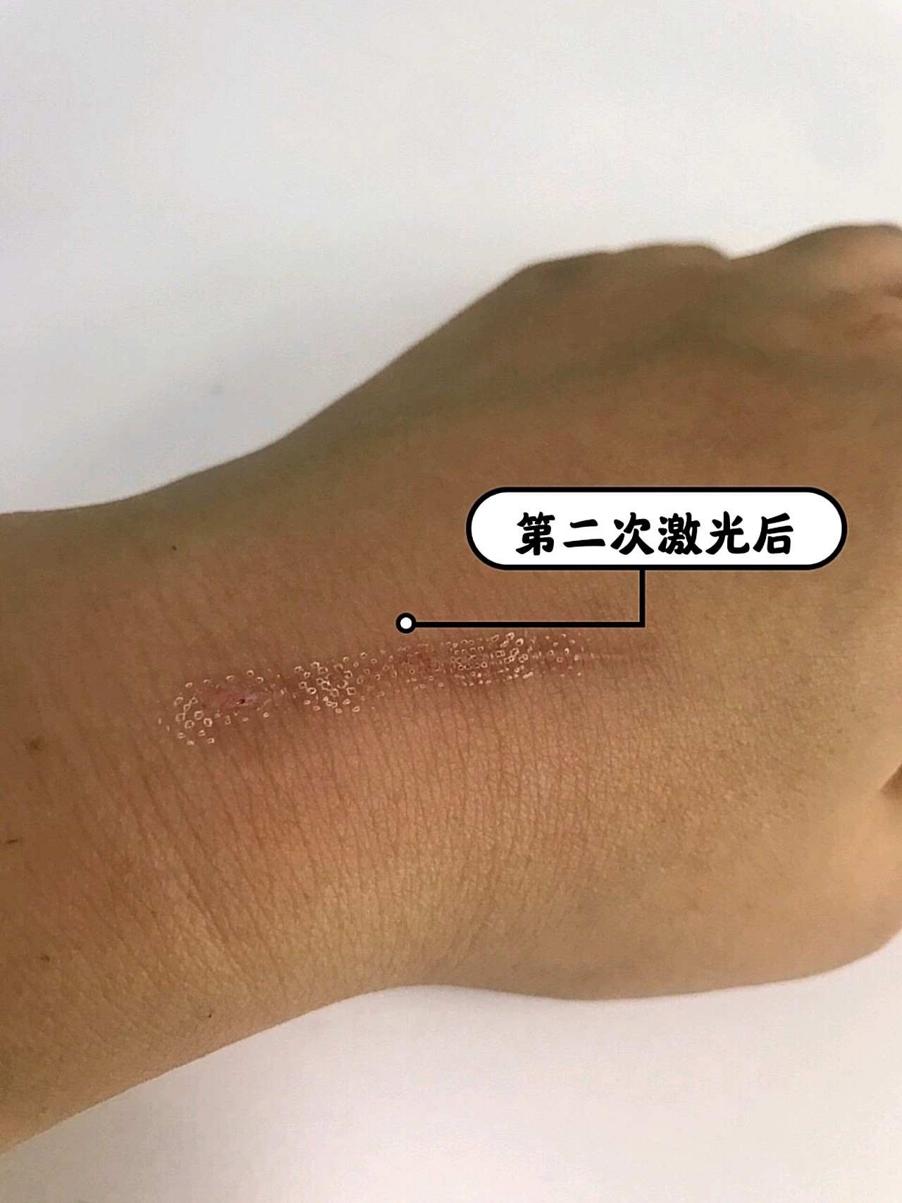 隔了两个月去做第二次激光祛疤,跟小伙伴们分享一下中_圈子-新氧美容