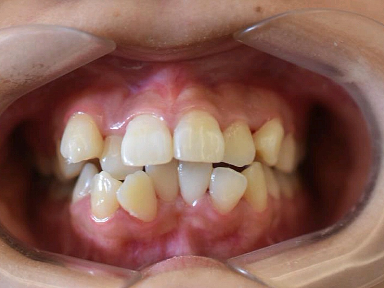 2018年6月做的矫正,牙齿前突比较严重,做了隐形矫正