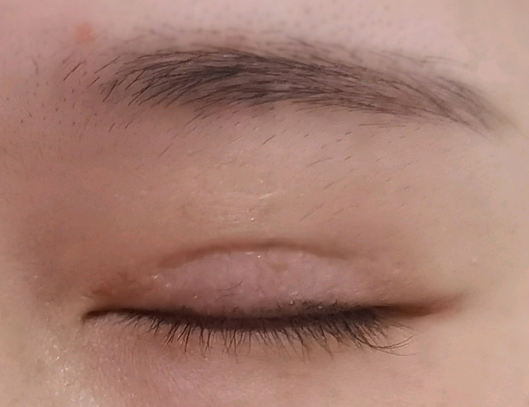 全切双眼皮修复8个月眼睛睫毛外翻明显是否还有可能恢复