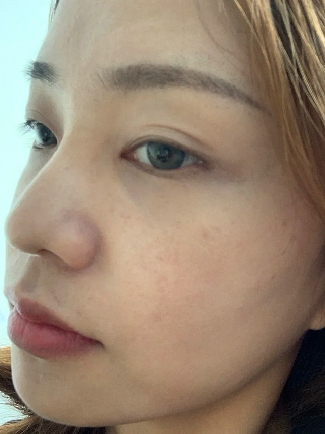 做完非剥脱脸确实细腻了很多,第一天的变化不会特别大_圈子-新氧美容