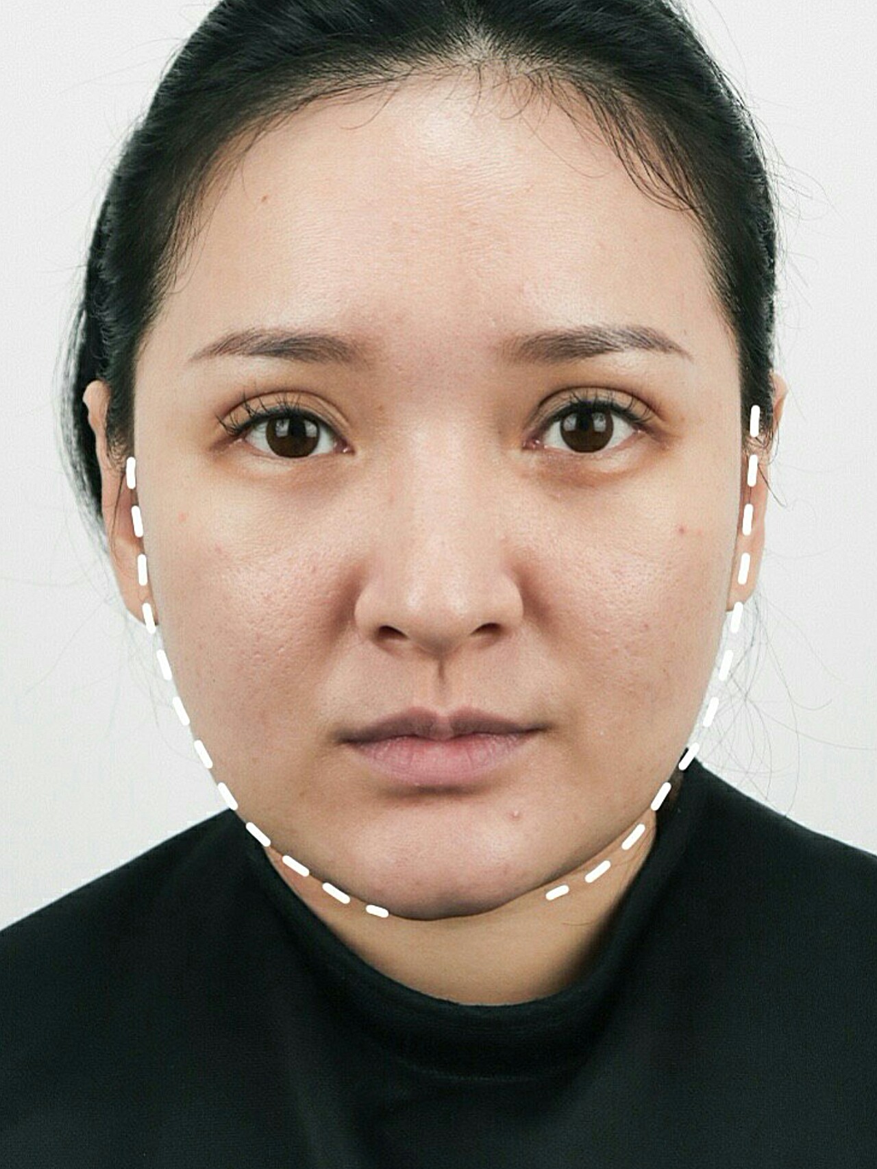 中面部下垂皮肤松弛细纹明显