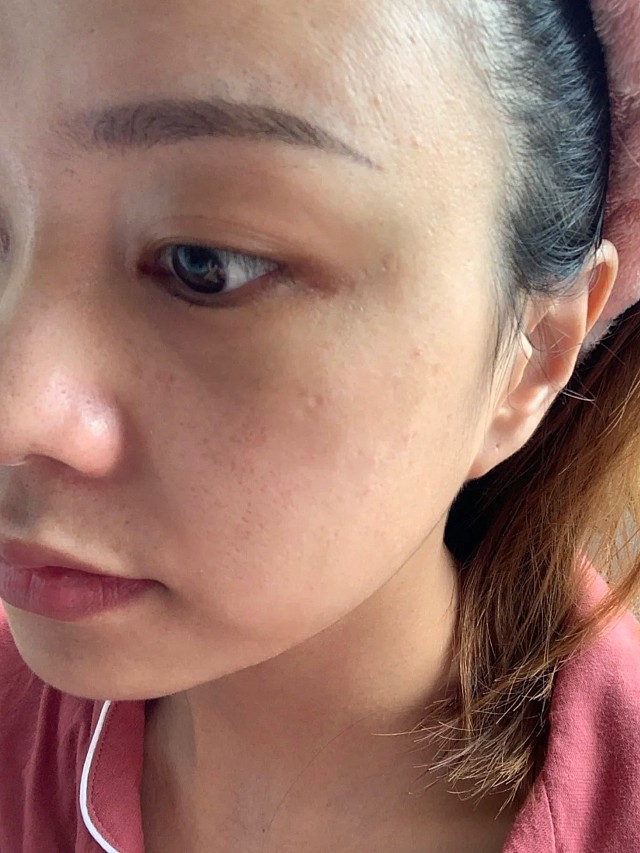 做完非剥脱脸确实细腻了很多,第一天的变化不会特别大_圈子-新氧美容