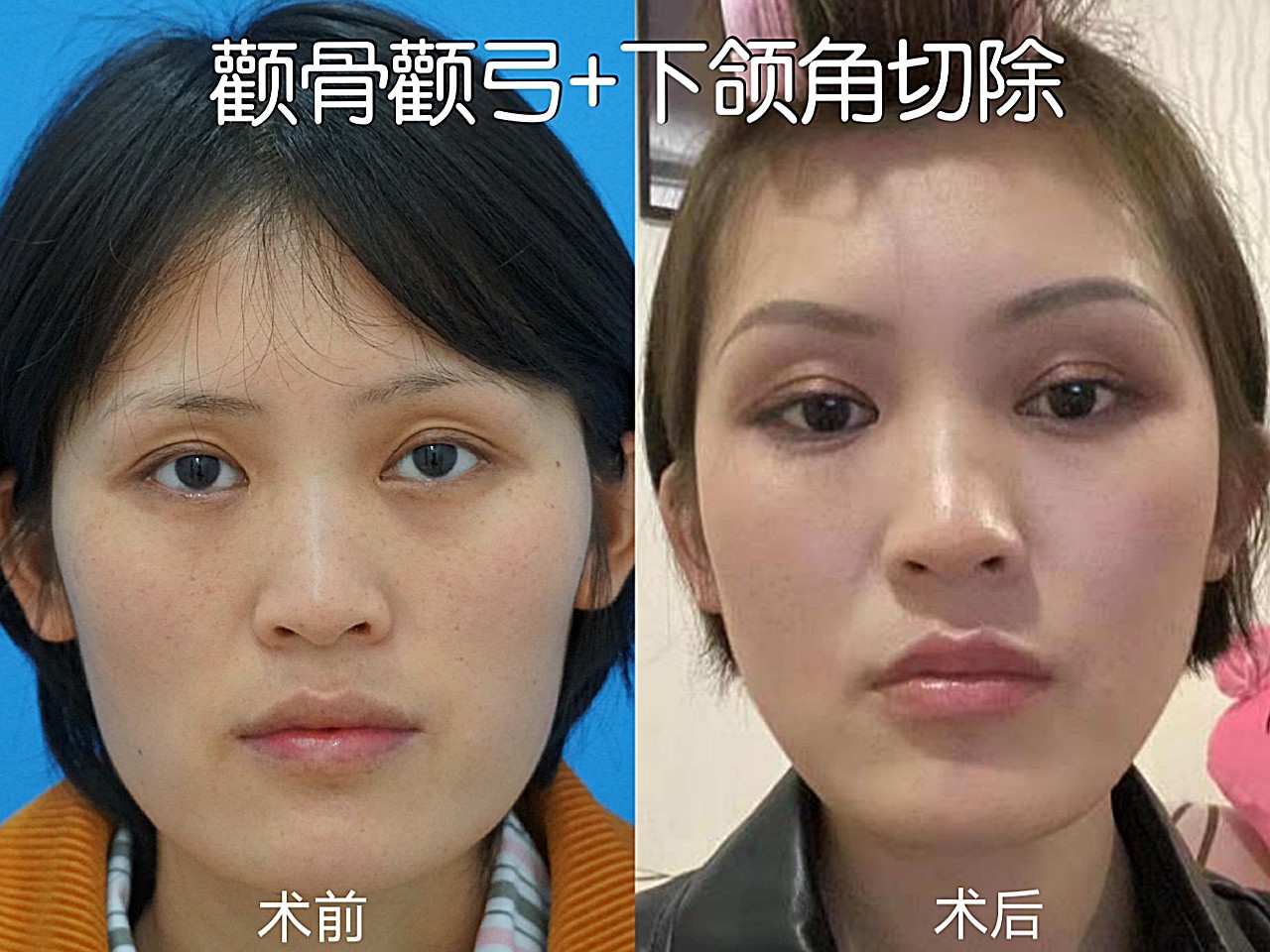 78颧骨颧弓降低下颌角切除78