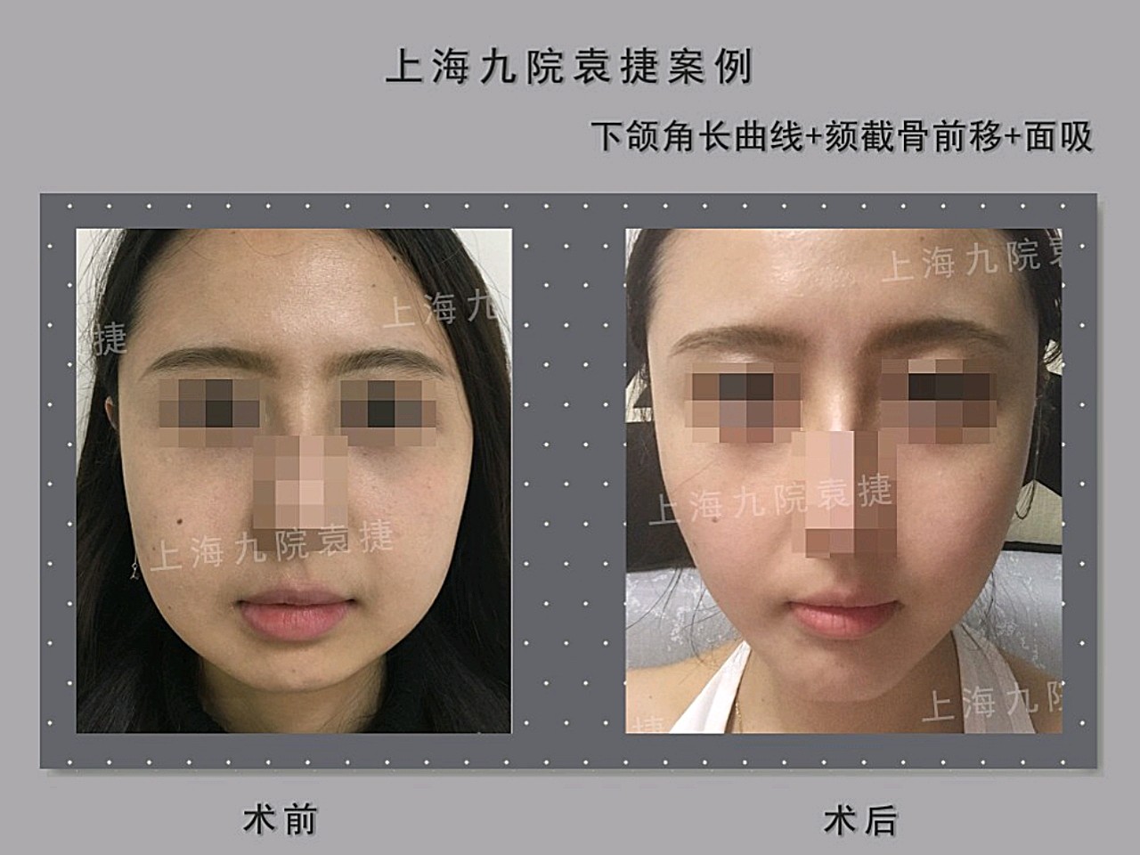 脸型分析:典型的下颌角骨骼发育肥大,下巴短且后缩_圈子-新氧美容整形