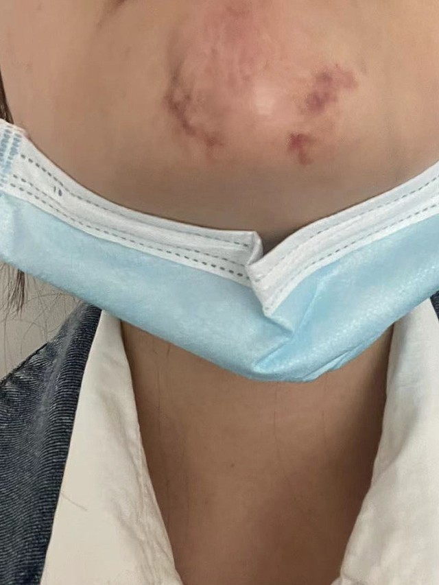 新氧体验官捷尔玻尿酸