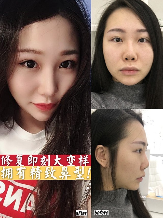 鼻修复大成功 鼻孔外翻一招就变美 姑娘自诉 之前 圈子 新氧美容整形