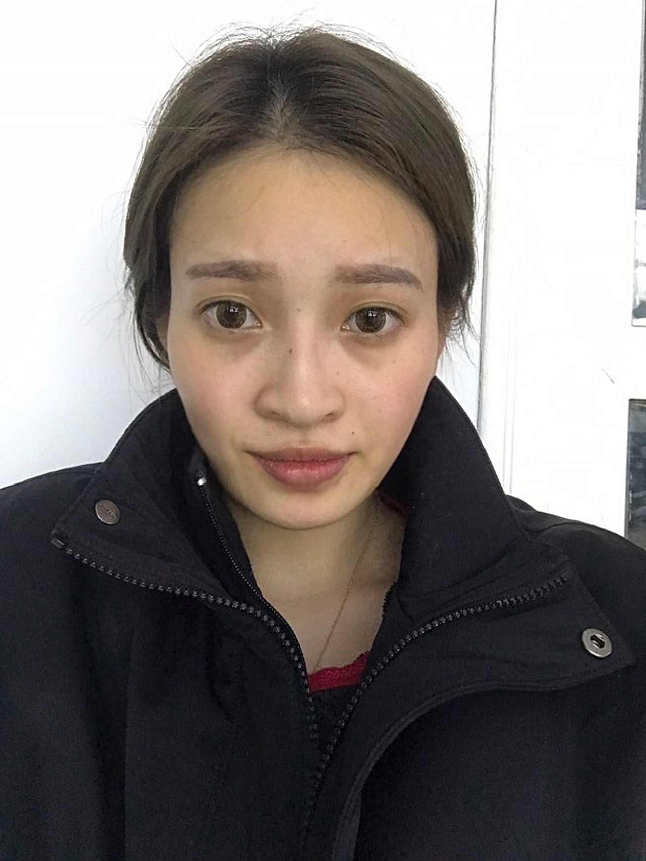 术前诊断术前问题:额头两边太阳穴凹陷,苹果肌也比较_圈子-新氧美容