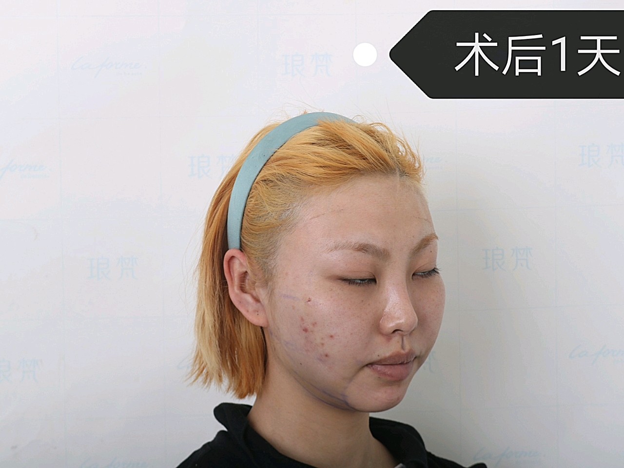 光纤溶脂术后一天对比