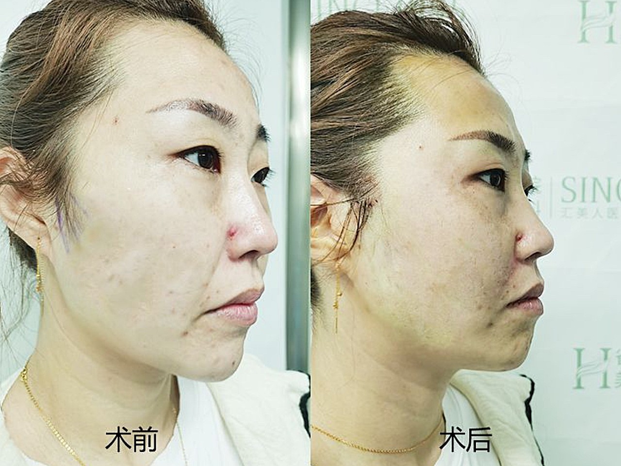 一直关注线雕这个项目,感觉不管是治疗的方式还是恢复的时间或是价格